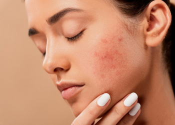 How to avoid acne?