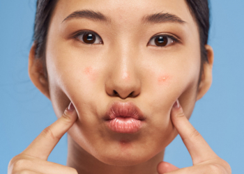 Face Mapping: understanding your imperfections 